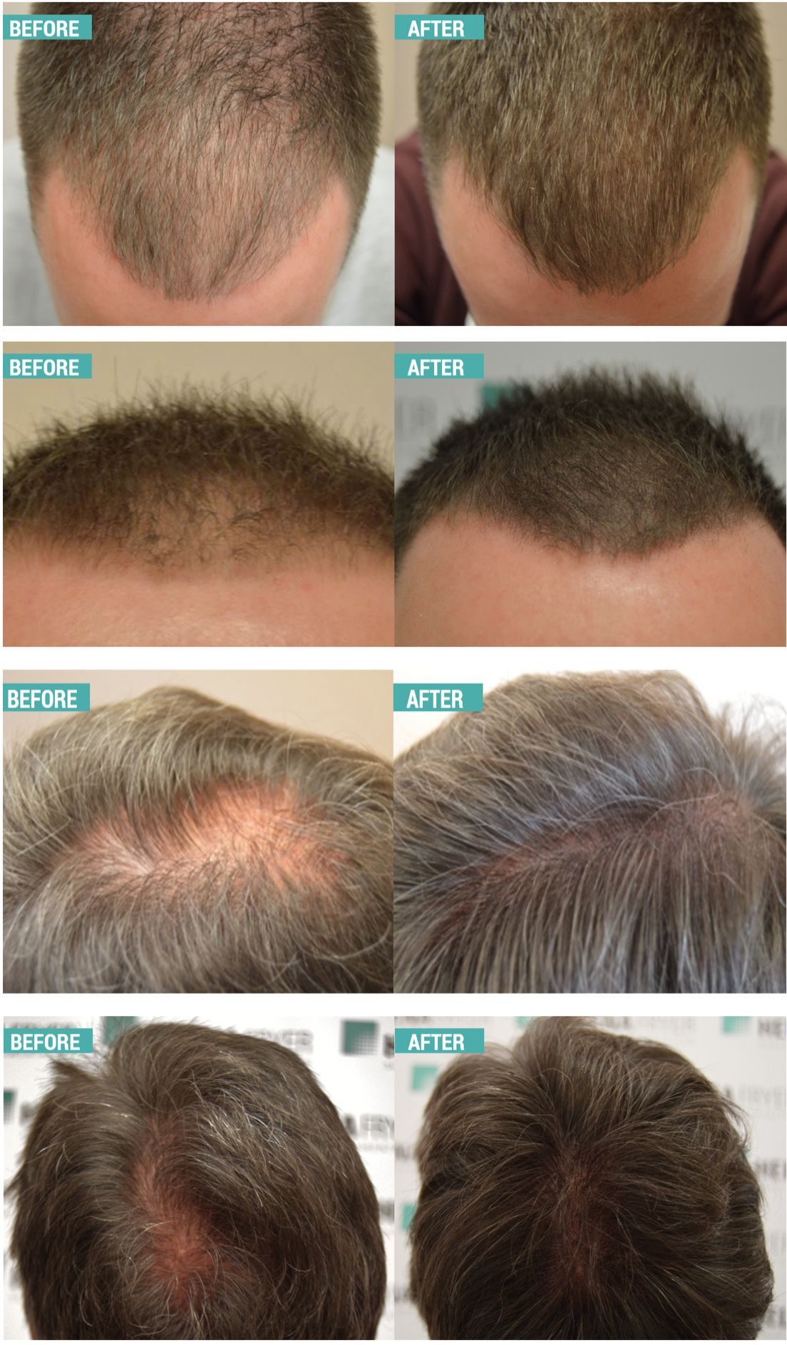 before and after scalp Micropigmentation in Cheshire